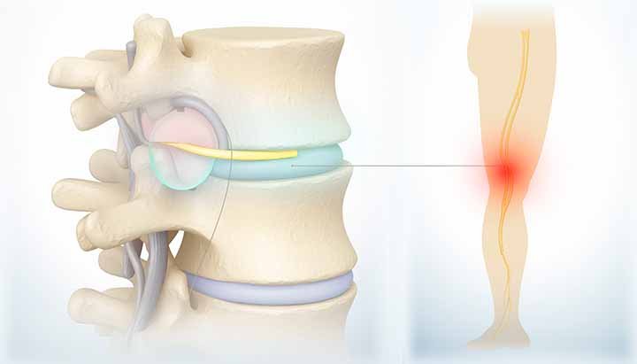 Compresión de nervios